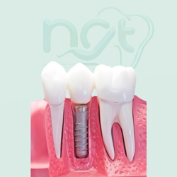 پروتز دندان