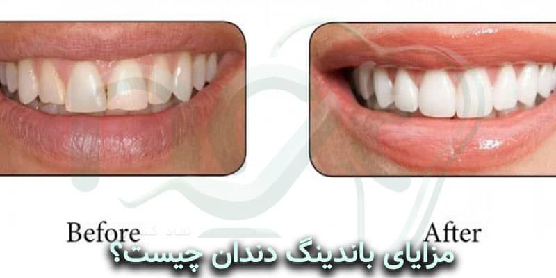  مزایای باندینگ دندان چیست؟